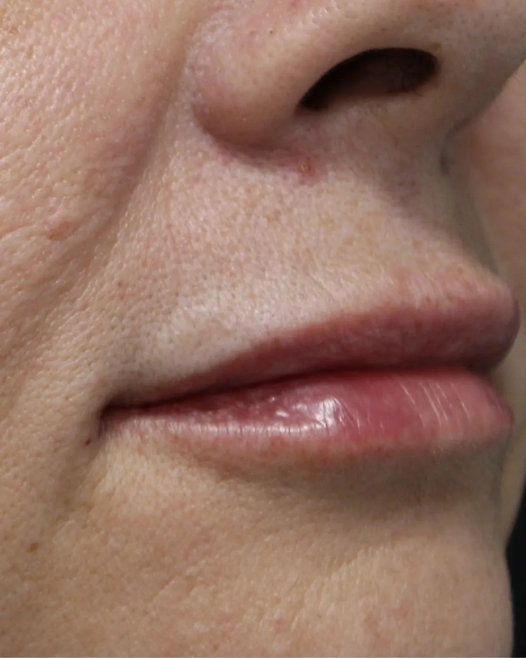 After upper and lower lip filler