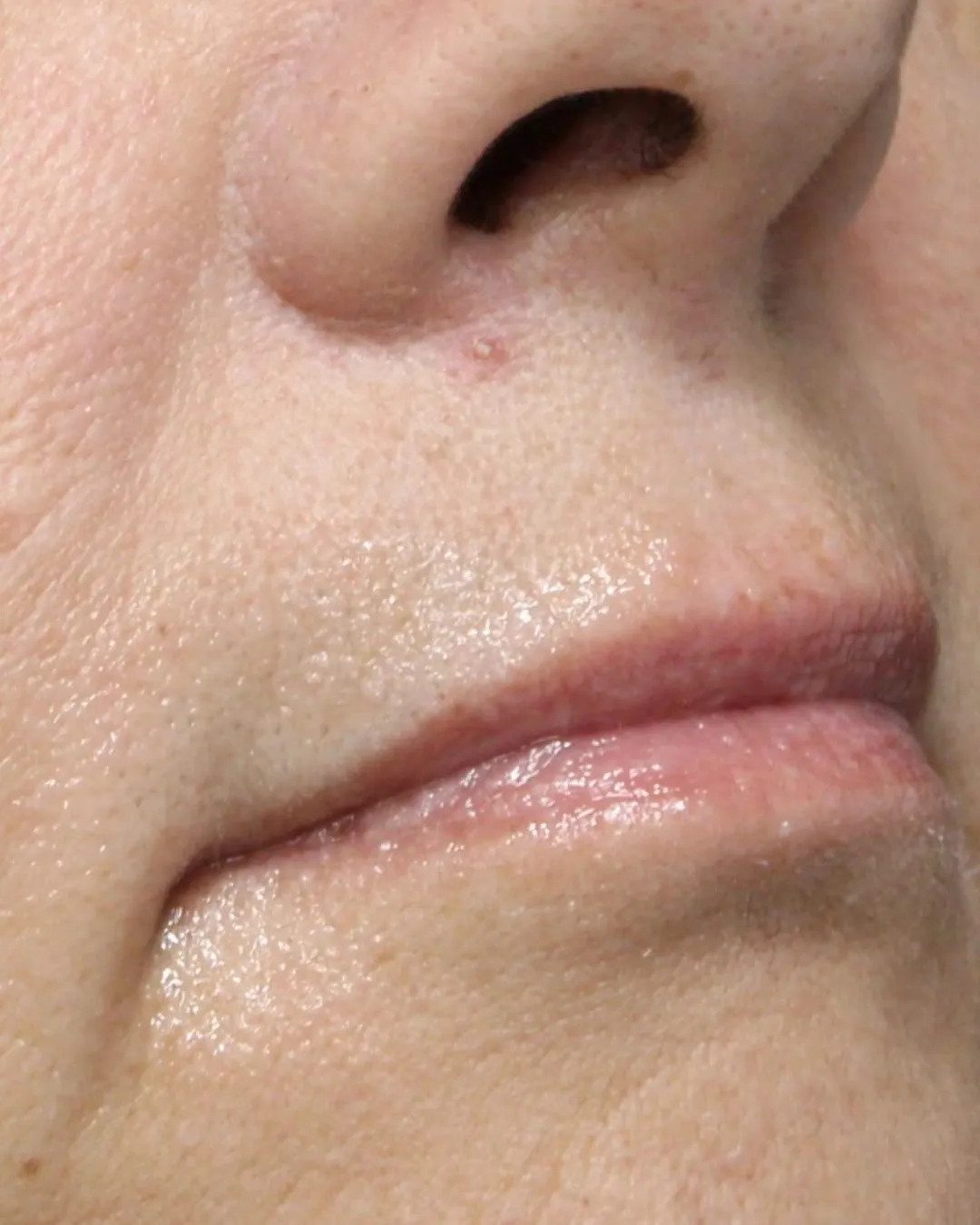 Before upper and lower lip filler