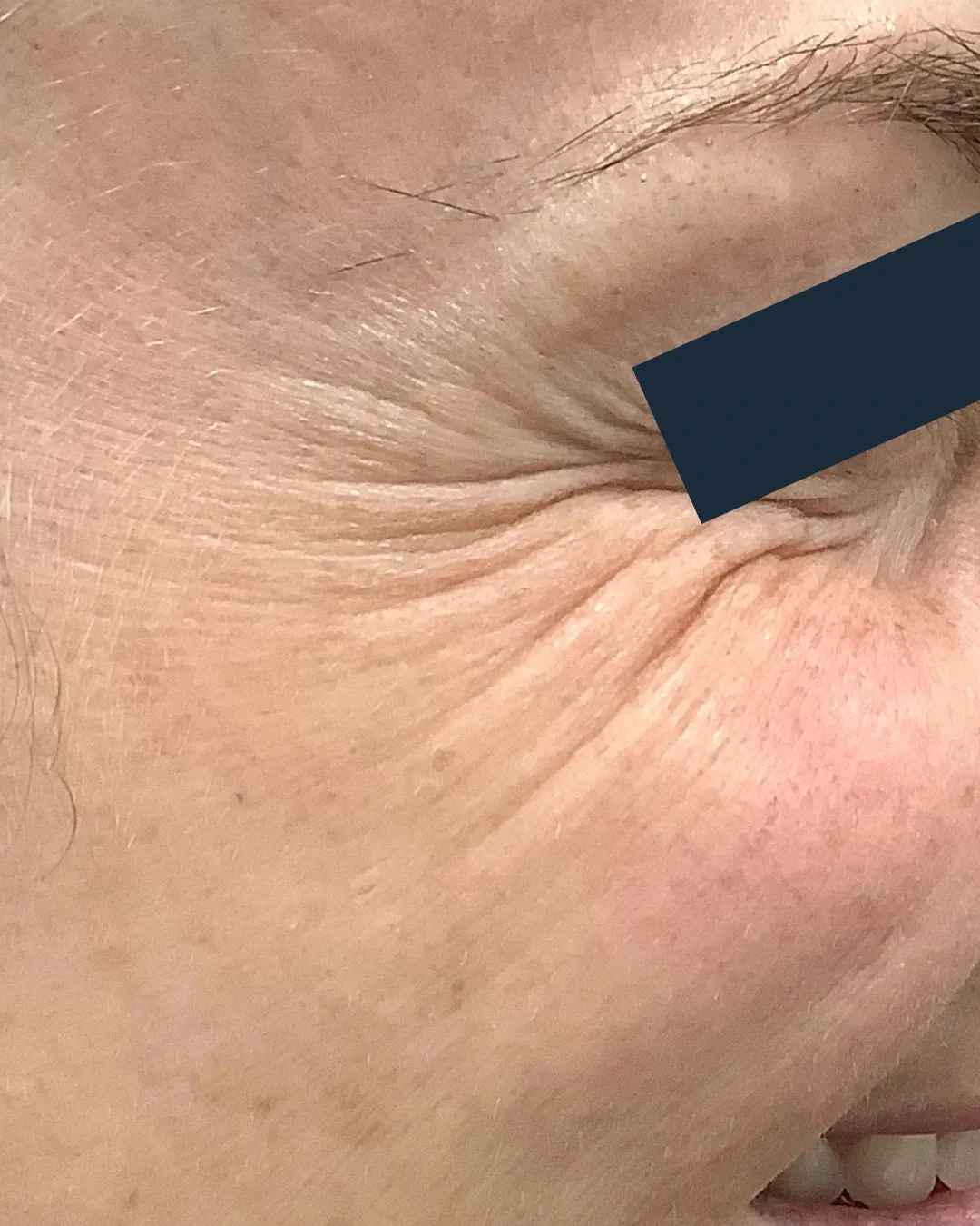 Before neuromodulator treatment for crow's feet